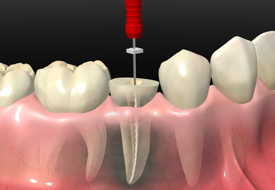🦷 Este mayo, recupera la salud de tus molares con nuestra promo de Endodoncia + Tapadur...
